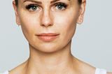 Hautbild verbessern: Hilfe gegen Akne, Falten und Co.: Pigmentflecken vorher