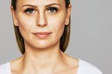 Hautbild verbessern: Hilfe gegen Akne, Falten und Co.: Pigmentflecken nach 10 Wochen
