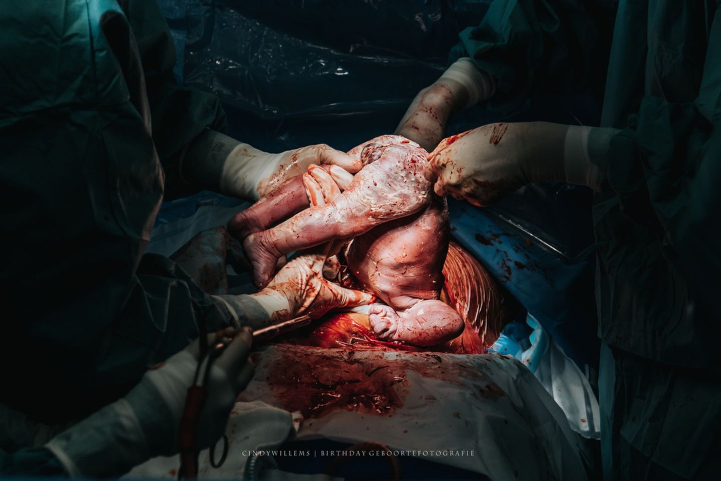 Geburtsfotos 2020: Kaiserschnitt mit Baby über Kopf