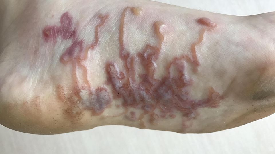 Gefährliche Parasiten: Hakenwürmer