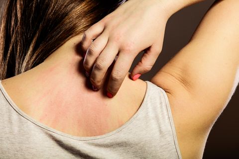Hautallergie: Frau kratzt sich am Nacken