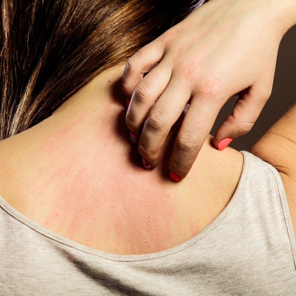 Hautallergie: Frau kratzt sich am Nacken