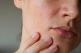 Hautprobleme: Frau mit unreiner Haut