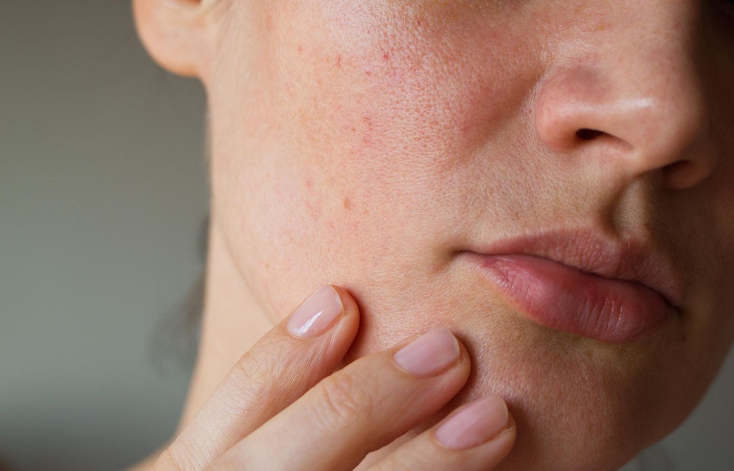 Hautprobleme: Frau mit unreiner Haut