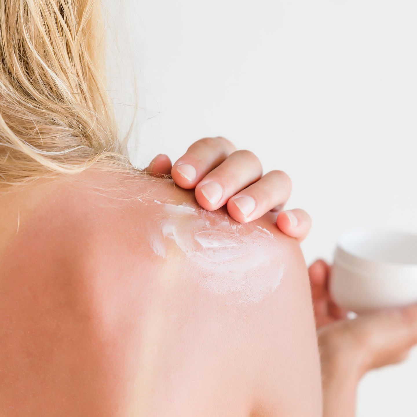 Hautprobleme: Frau mit Sonnenbrand