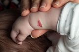 Väter: Baby mit Blutschwamm am Arm
