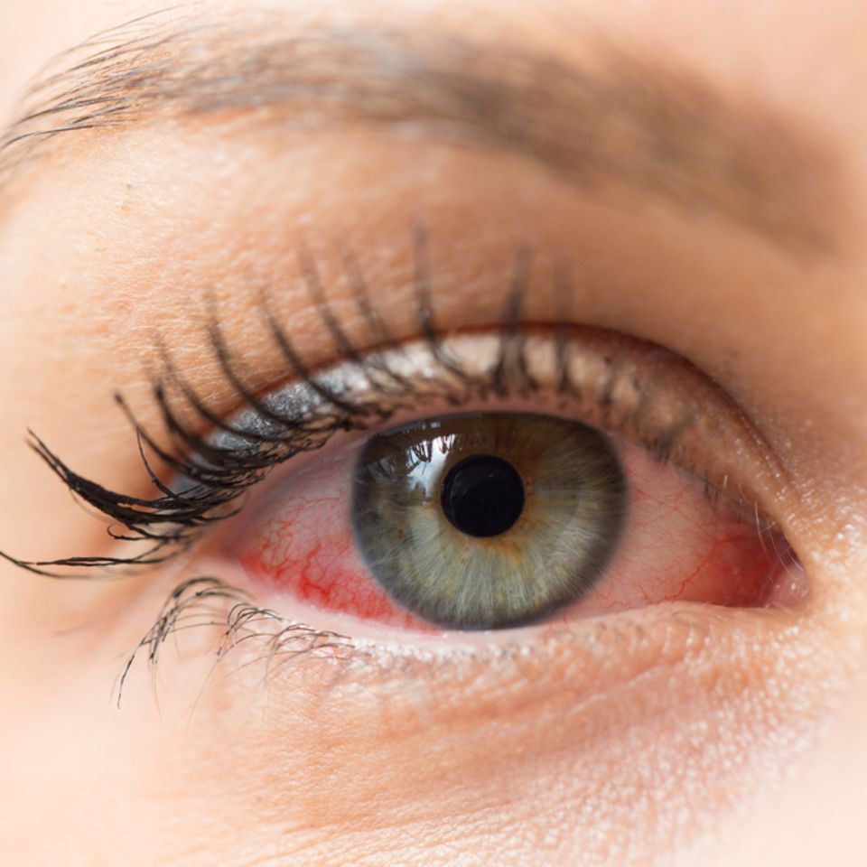 Bindehautentzündung-Hausmittel: Frau mit rotem Auge