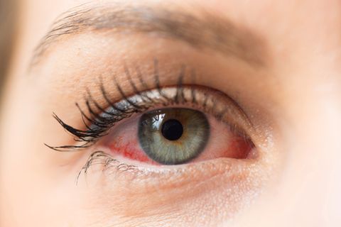 Weg auge geht herpes im nicht Herpes im