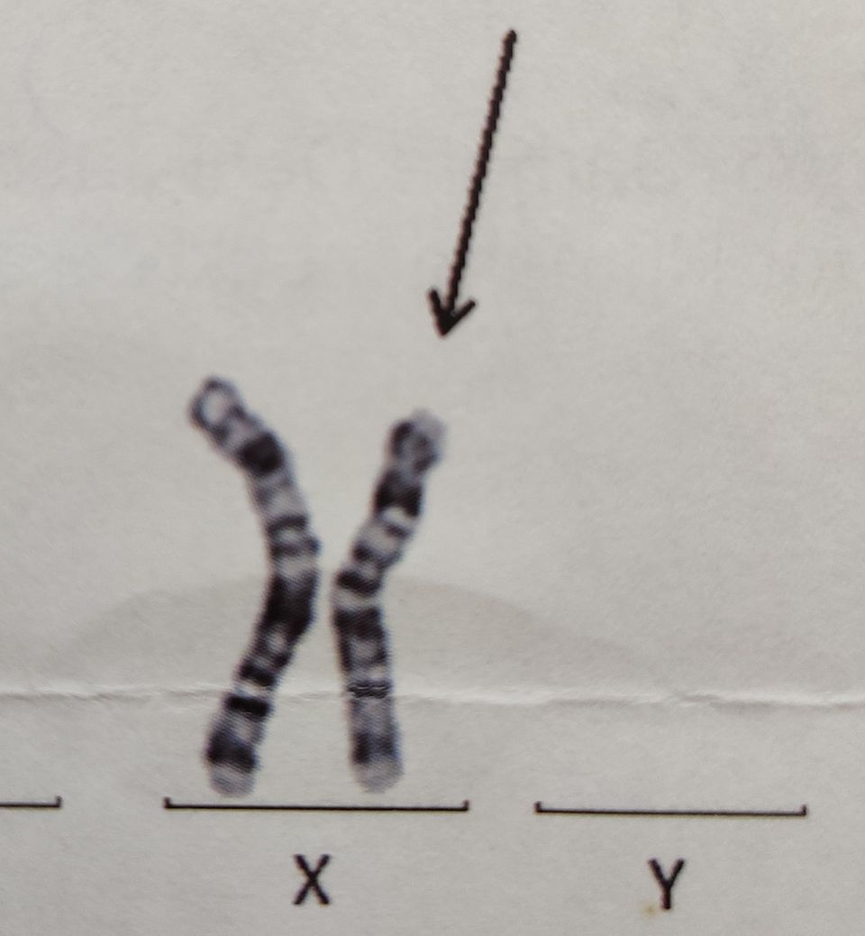 Janas X-Chromosom