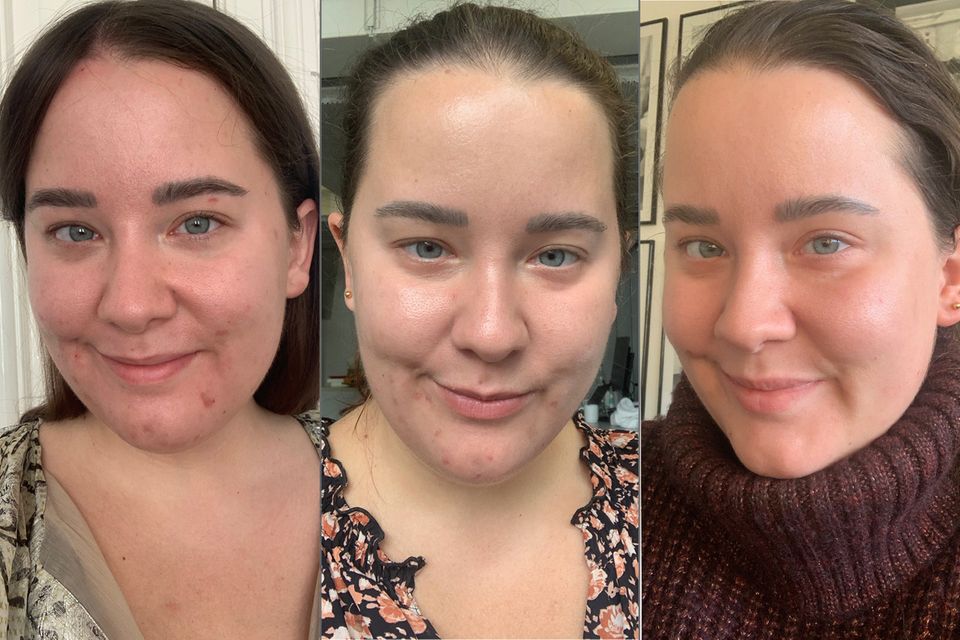 My skin at the start of treatment (left), after four weeks (middle) and now (right)