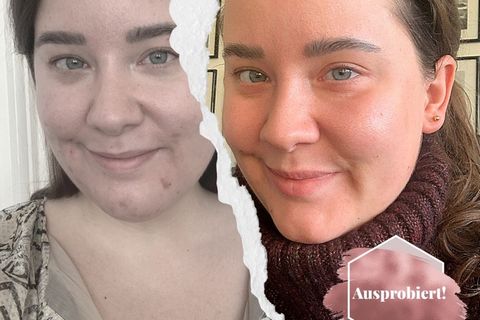 Akne mit 32!: Ich habe den Hautarzt für zu Hause getestet – und so sieht mein Gesicht jetzt aus
