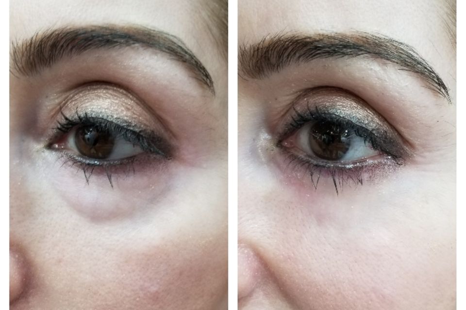 Vorher/Nachher Effekt bei Anwendung der Vitayes Lifting Creme Vorher/Nachher Effekt bei Anwendung der Vitayes Lifting Creme
