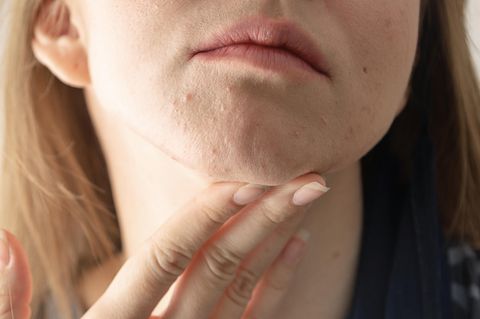 Hypersensible Haut: Frau mit irritierter Haut