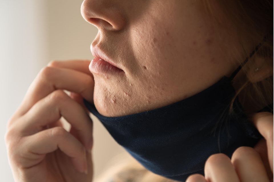 Hypersensible Haut: Frau mit Maskne