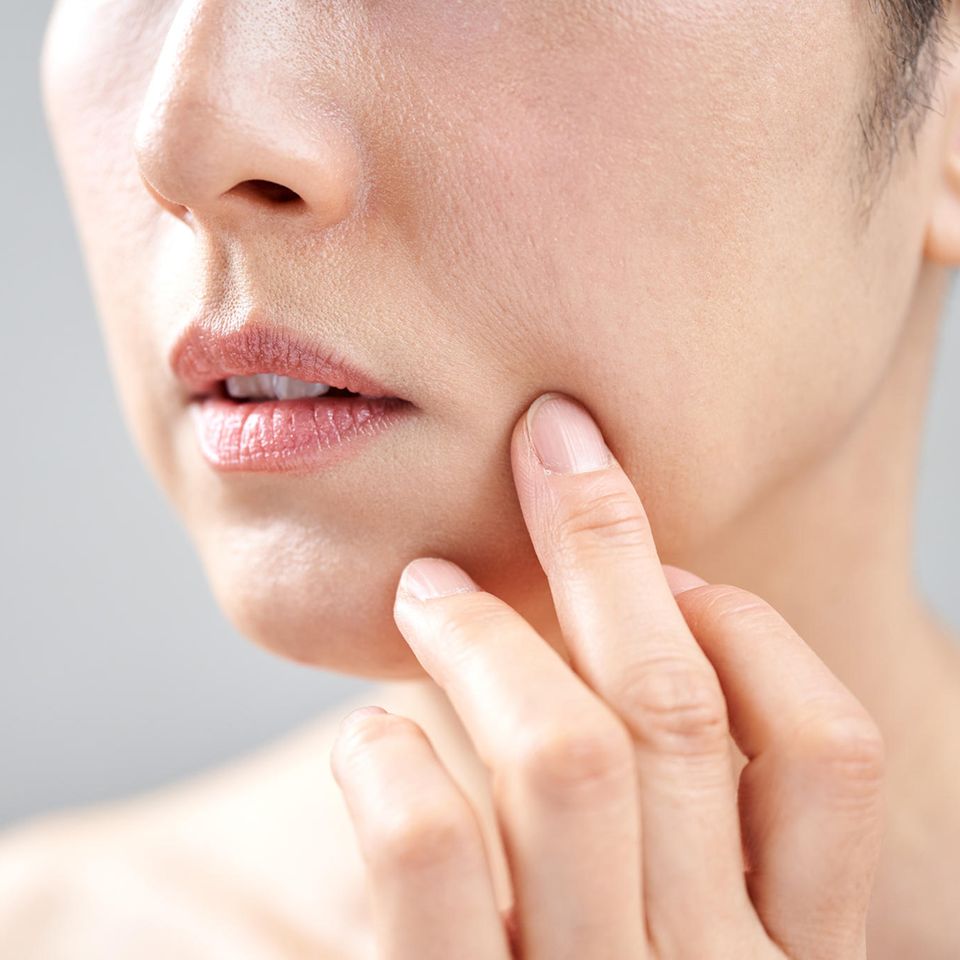 Periorale Dermatitis zeigt sich vor allem um Nase und Mund herum