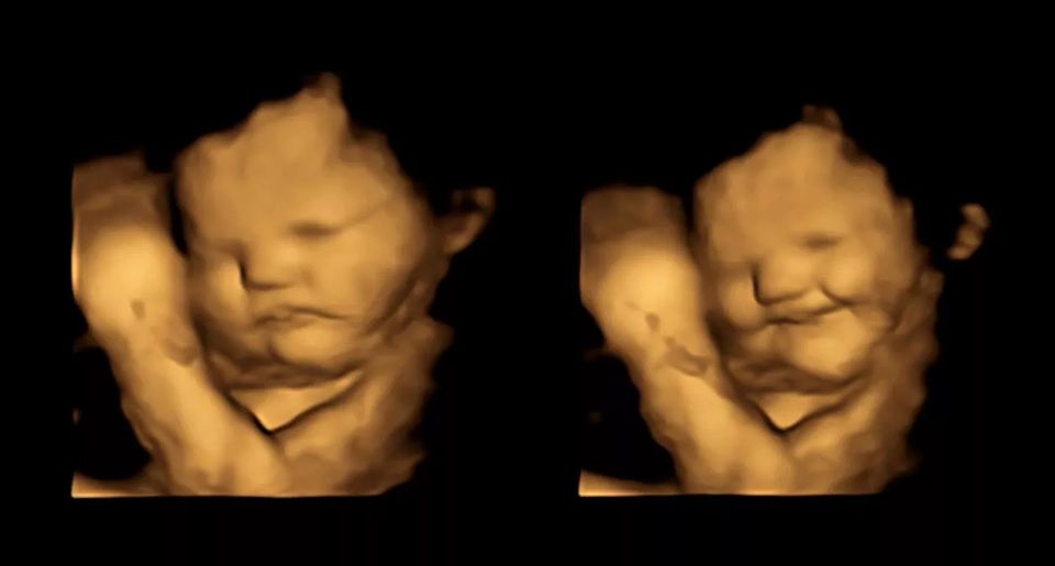 4d-ultraschall-scan-babys