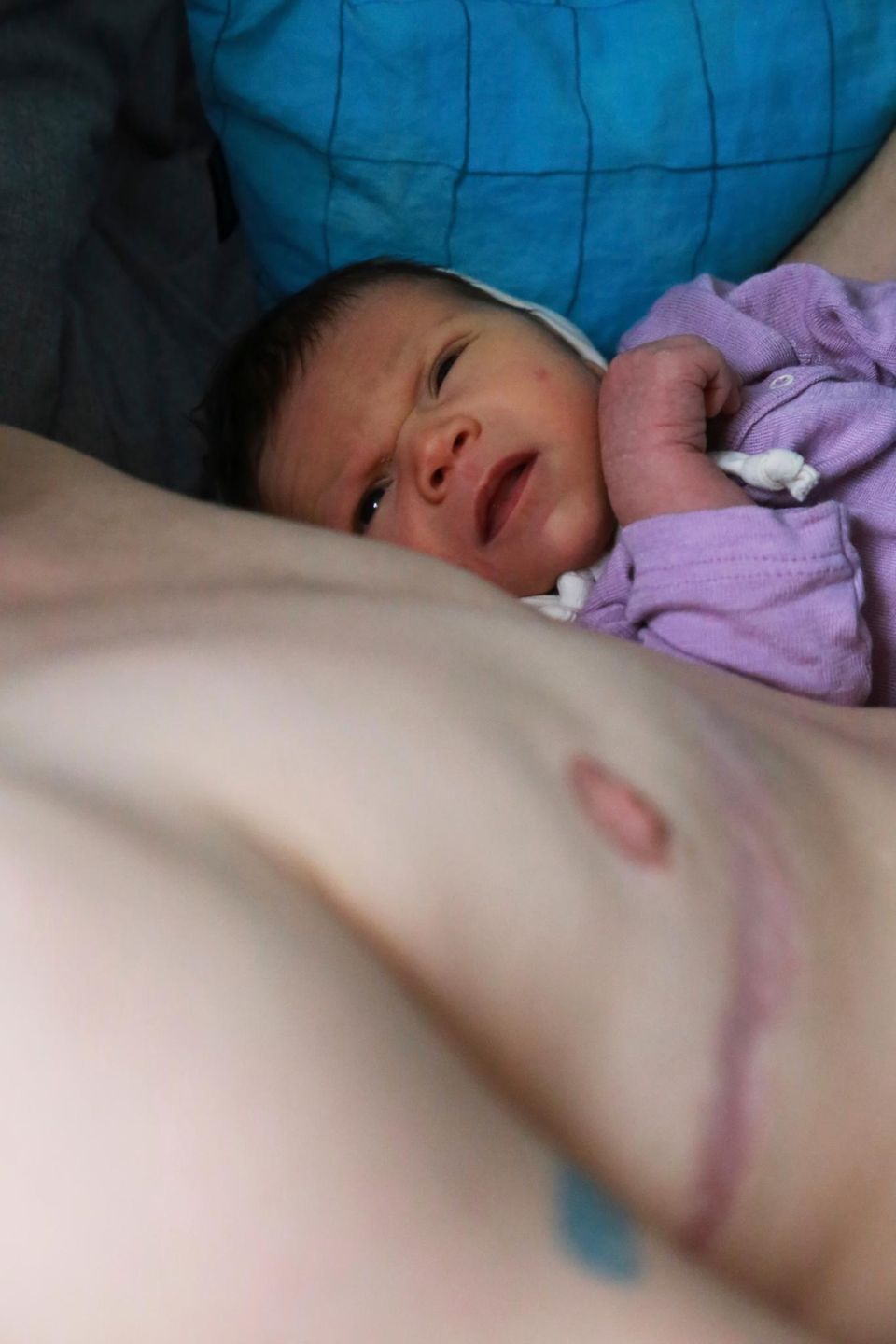 Motherhood: Säugling liegt auf Brust mit Narbe