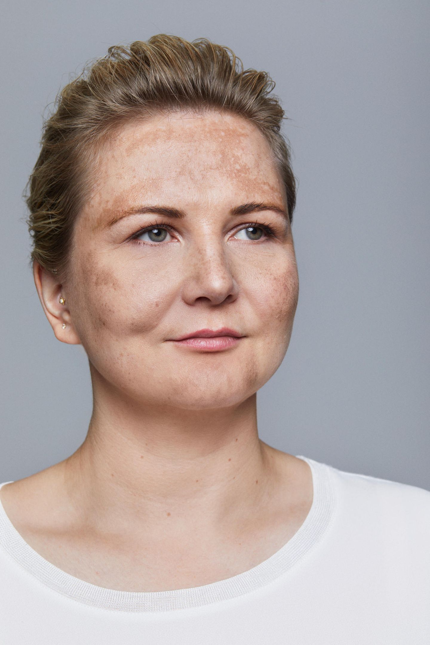 Julia, 38  Sommersprossen hatte Julia schon immer, doch nach der Pille, die sie vor allem wegen unreiner Haut und starke Regelschmerzen nimmt, kommen auch größere Flecken dazu. Zwar hilft abdecken, aber auf Dauer ist das keine Lösung für Julia. Regelmäßige Behandlungen wie Peelings und Microdermabrasion hatten jedoch zuvor kaum eine Wirkung auf ihre stärker werdenden Pigmentflecken an Stirn und Wangen.