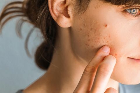 Knibbeln, kratzen, kauen: Ist "Skin Picking" harmlos oder ein psychisches Problem?