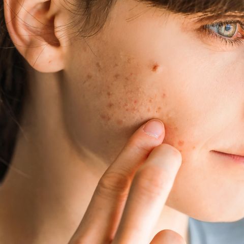 Knibbeln, kratzen, kauen: Ist "Skin Picking" harmlos oder ein psychisches Problem?