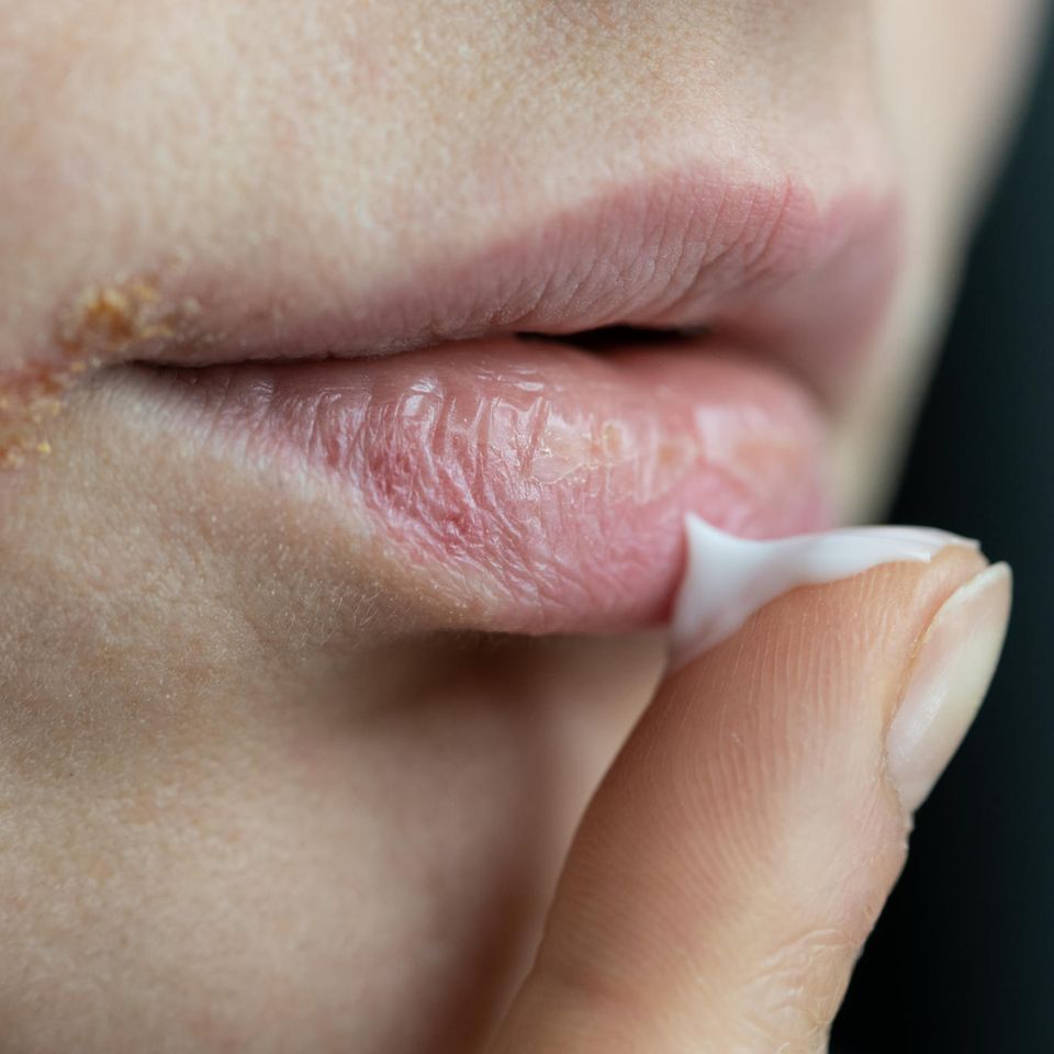 Eingerissene Mundwinkel: Frau cremt sich die Lippen ein