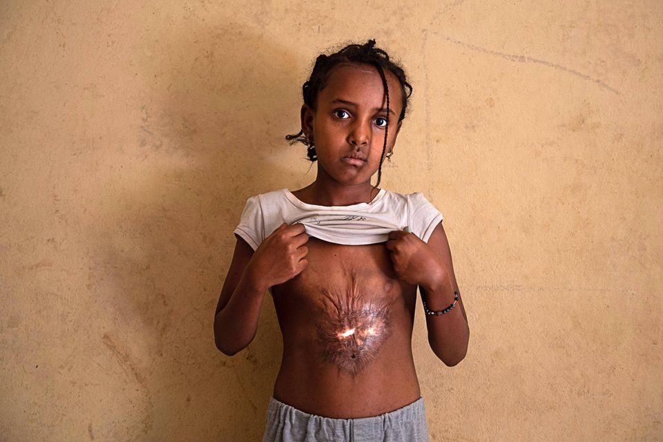 Ein Mädchen zeigt Narben, die ihr von Eritrea-Soldaten zugefügt wurden