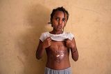 Ein Mädchen zeigt Narben, die ihr von Eritrea-Soldaten zugefügt wurden
