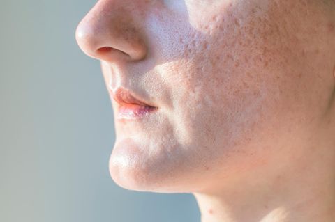 Löcher in der Haut: Nahaufnahme von Aknenarben auf der Wange