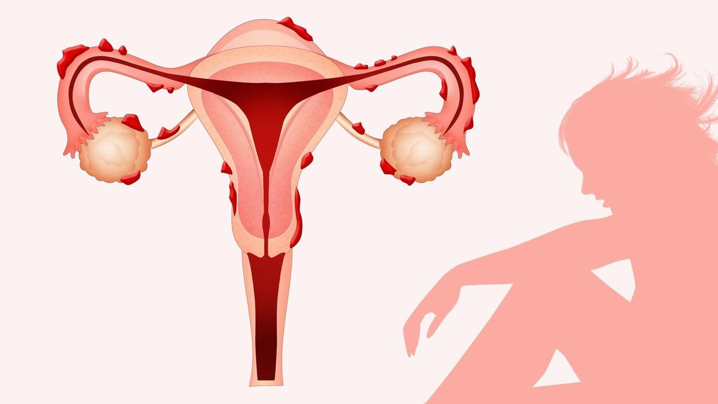 Frauen leiden: Warum Endometriose in den Wechseljahren zurückkehrt