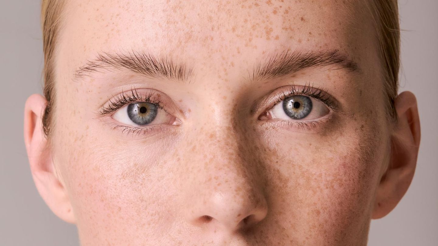 Gekommen-um-zu-bleiben-Die-richtige-Pflege-bei-Pigmentflecken