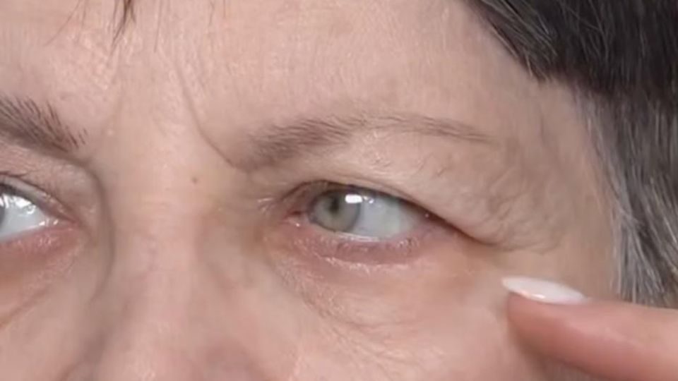 Нависшее веко